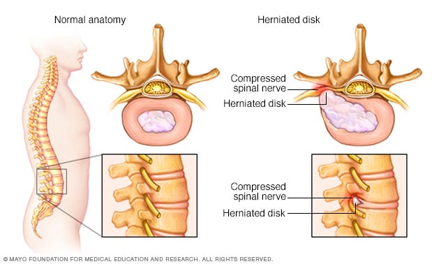normal and herniated disks