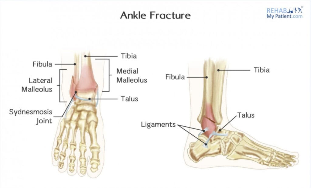 Fractures