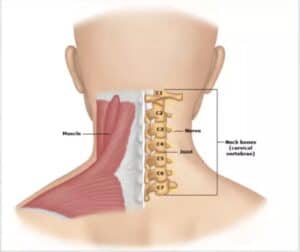 neck pain
