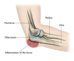 swollen elbow
