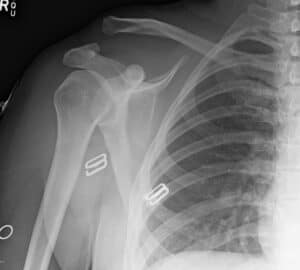 shoulder pain