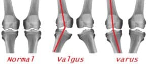 knee injury