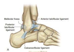 ankle sprain