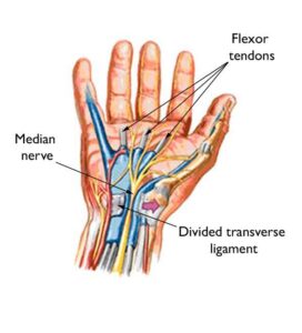 Carpal Tunnel Syndrome