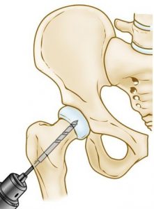 Avascular Necrosis