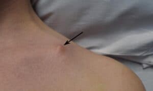 Clavicle Fracture