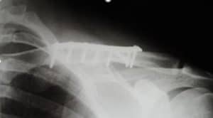 Clavicle Fracture
