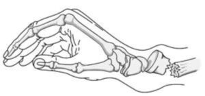 Distal Radius Fracture
