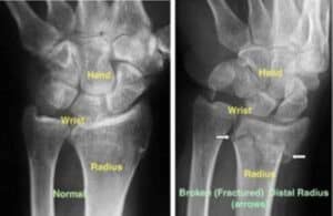 Distal Radius Fracture