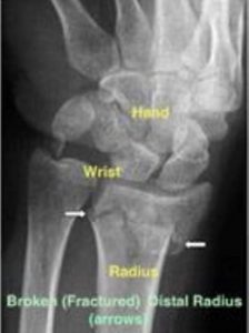 Distal Radius Fracture