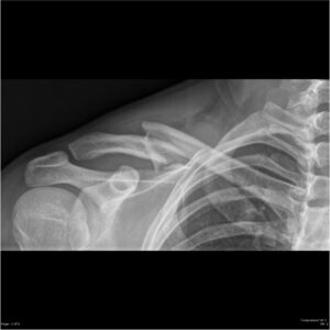 Clavicle Fracture