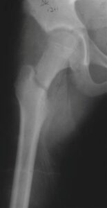Proximal Femur Fractures