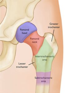 Proximal Femur Fractures