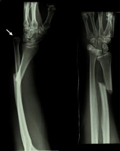 An open fracture