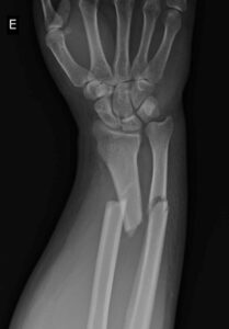 What is a forearm fracture