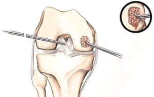 Cartilage Lesions