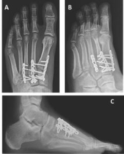 Lisfranc Fracture Dislocation