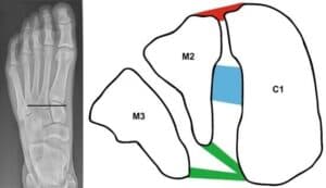 Lisfranc Fracture Dislocation