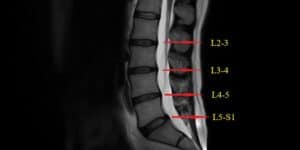 spondylitis treatment