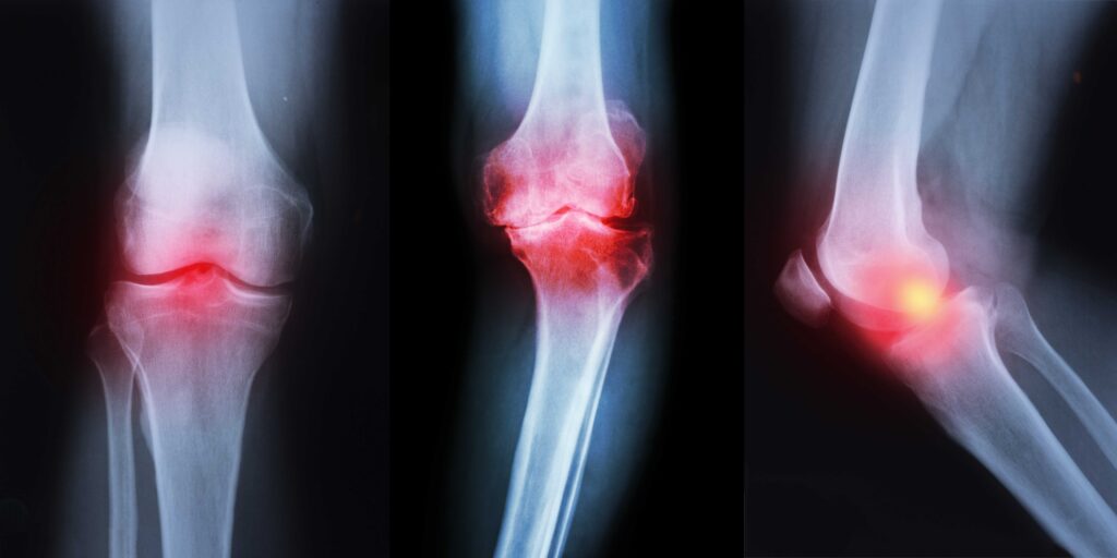 best relief for arthritic knees