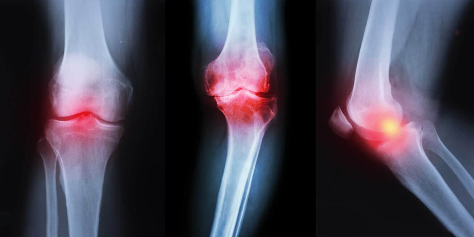 Understanding Knee Arthritis Causes, Symptoms & Treatment