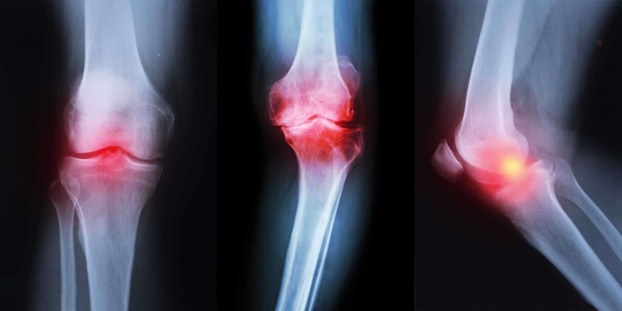 Understanding Knee Arthritis Causes, Symptoms & Treatment