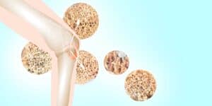 osteoporosis specialist doctor near me