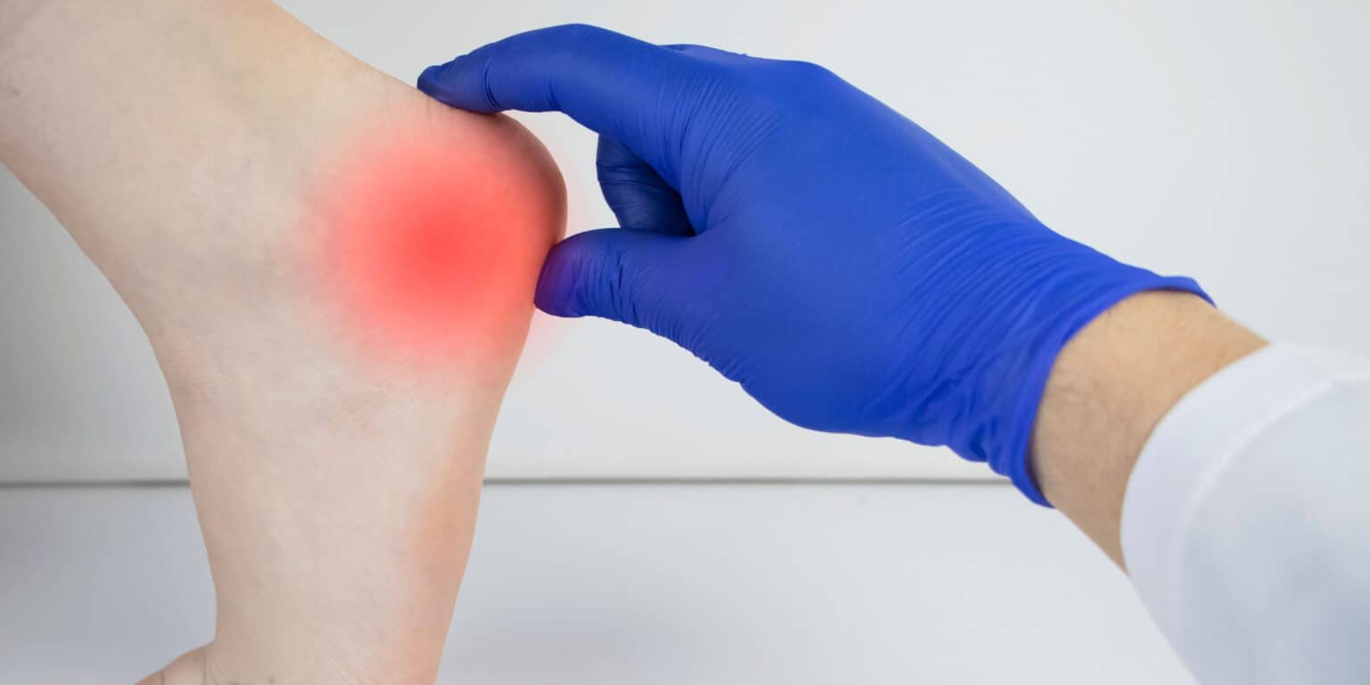 What are Spurs on the Foot? The Orthopaedic & Pain Practice