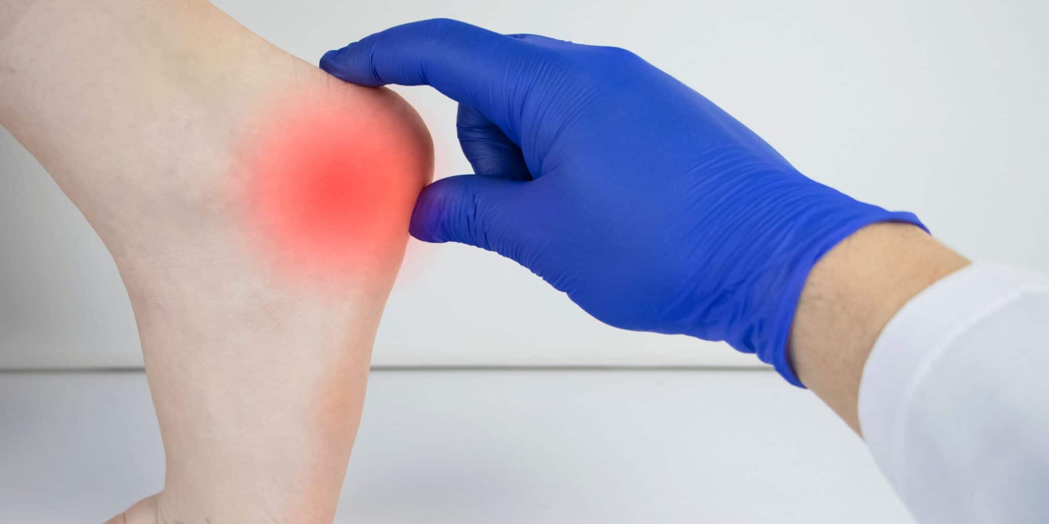 Understanding Foot Spurs Causes, Symptoms, and Treatment