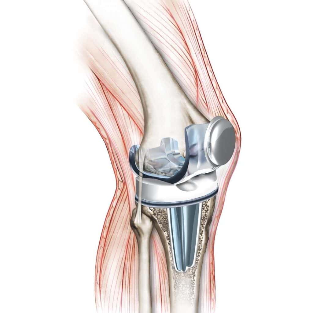 knee replacement after acl surgery