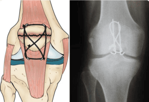 Patella Fractures