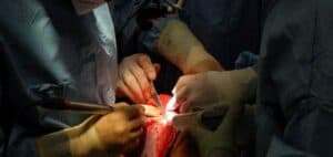 forearm fracture
