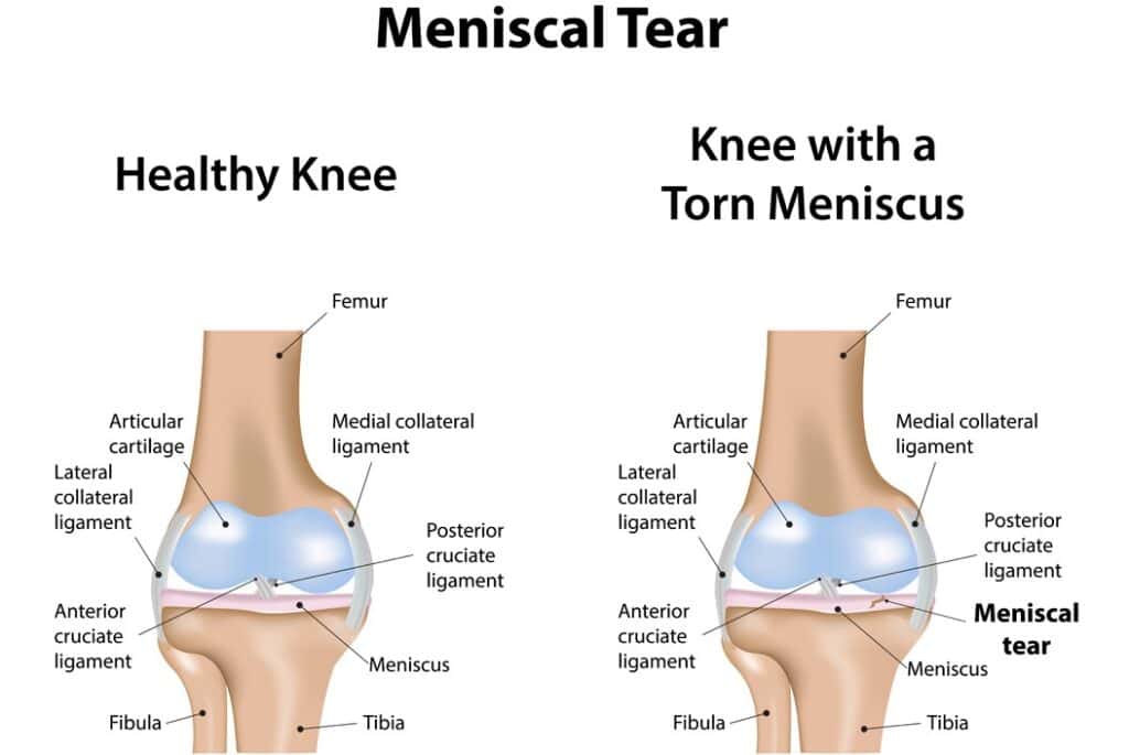 Meniscal Tears