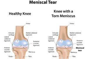 Meniscal tears