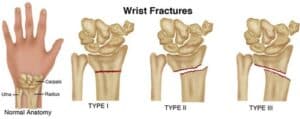 wrist fracture