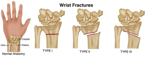 broken bones
