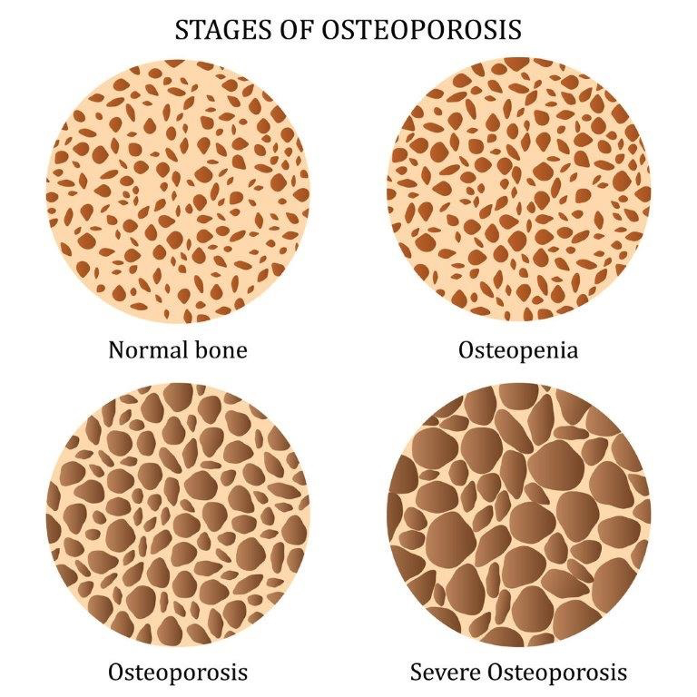 Low Bone Density, osteoporosis