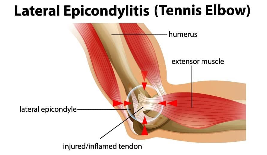 treatment for tennis elbow pain