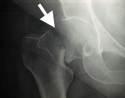 what is best treatment for low bone density