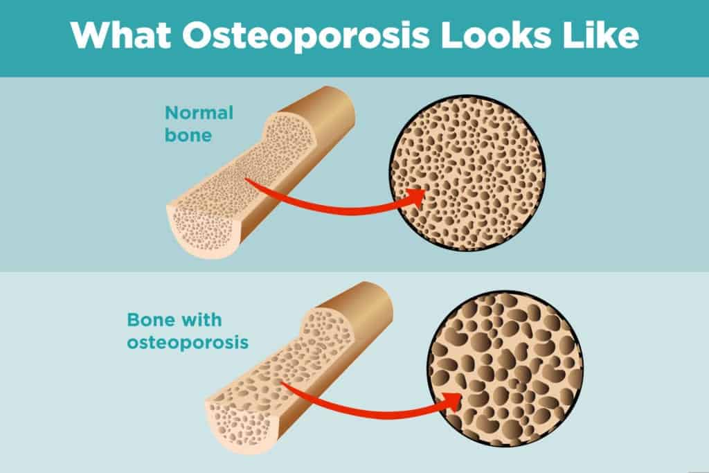 treatment for poor bone density
