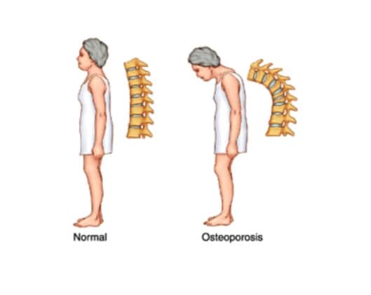 doctors specializing in osteoporosis near me