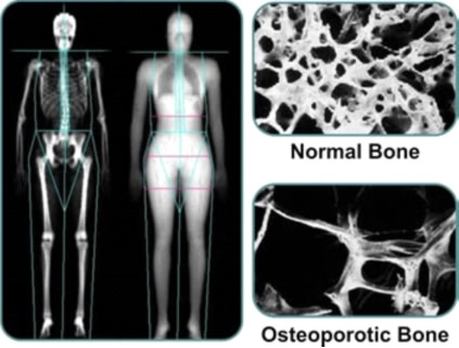doctors specializing in osteoporosis near me